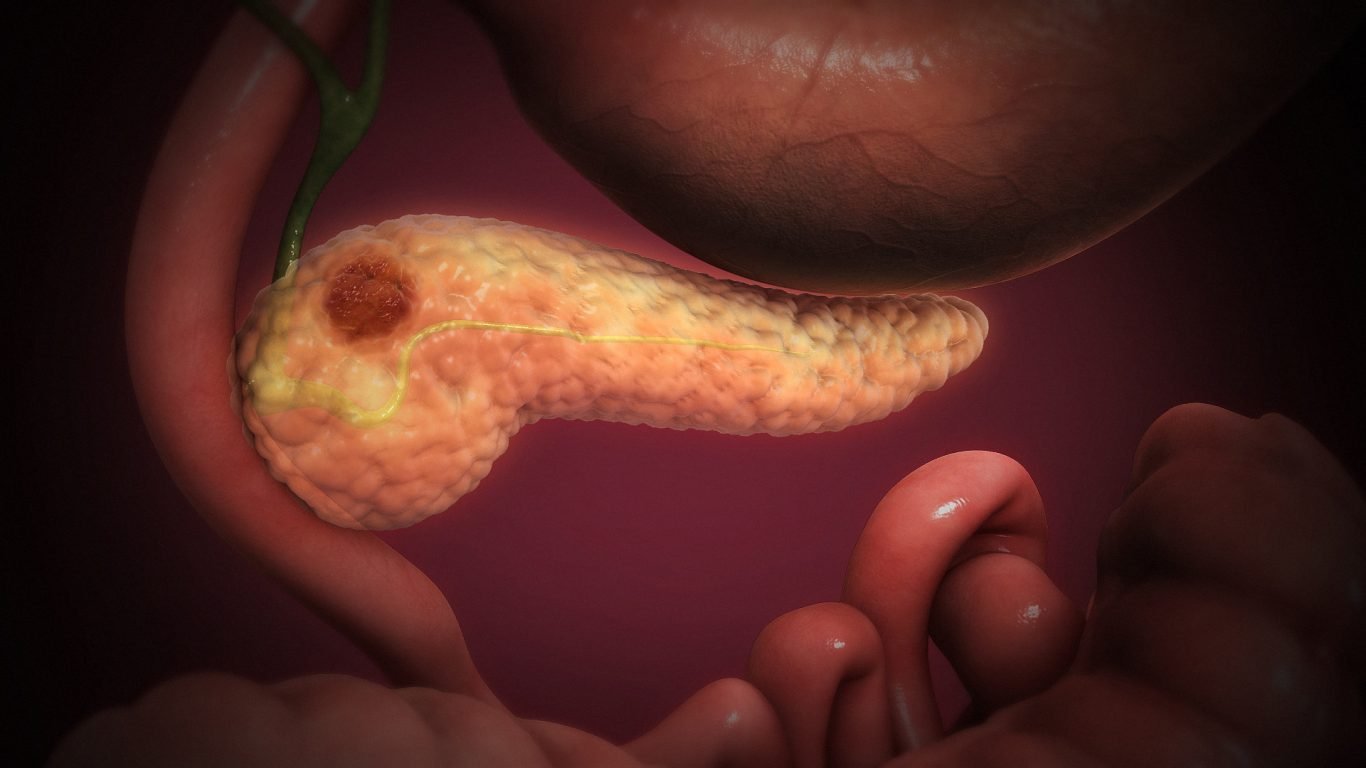 Cancerous cells forming a lump in the pancreatic tissue. by Scientific Animations Inc