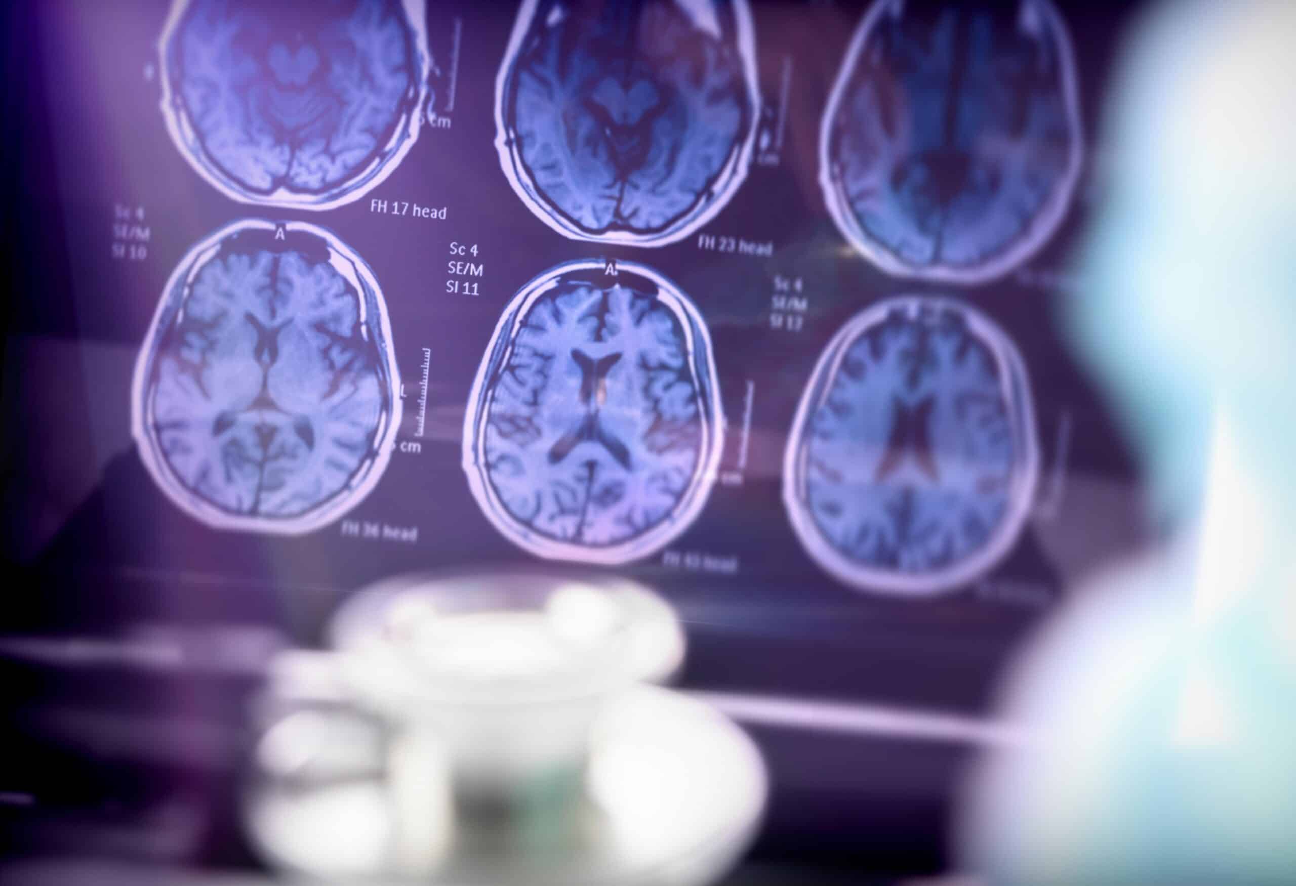 Alzheimer disease | Scientific analysis of Alzheimer's disease in hospital, conceptual image